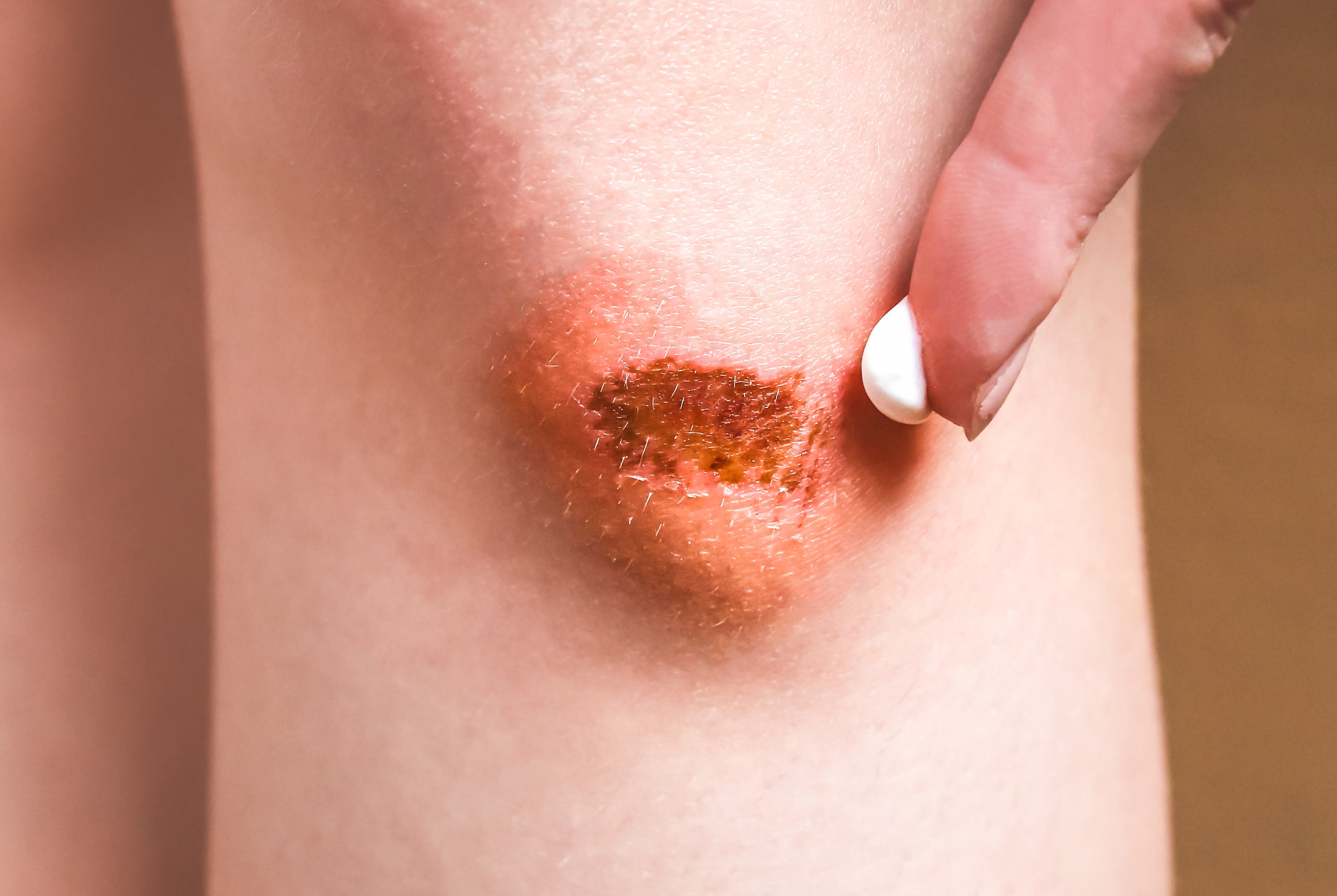 Acceleration of Open-Wound Healing and Ischemic Tissue Salvage with GHK-Cu (Copper Peptide)